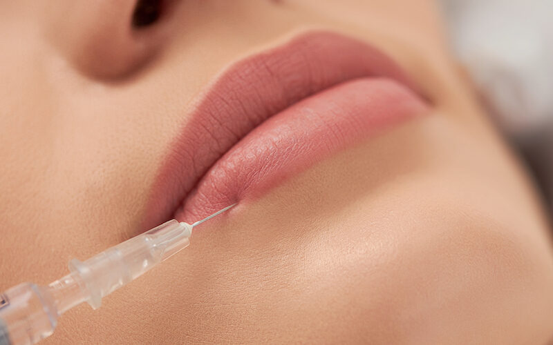 Lip fillers